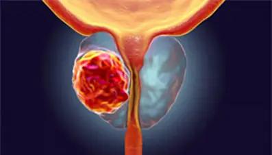 Tumore della prostata